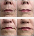 /album/galeria-de-fotos-dermaroller/dermaroller-wrinkle-before-after-jpg/